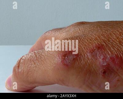 dermatite da eczema non contagiosa della pelle a portata di mano. pelle secca e pruriginosa intorno alle articolazioni delle dita della mano. pelle gonfia e gonfia. problema dermatologico Foto Stock