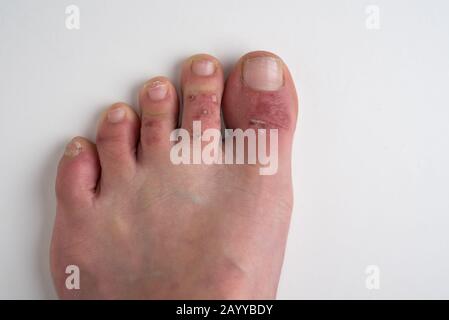 Amman/ Jordan - Febbraio 05 2020, dermatite anche conosciuto ed Eczema, causando rash, secchezza, prurito ai piedi di una femmina di 40 anni Foto Stock