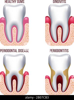 Malattie delle gengive umane, sanguinamento delle gengive, prevenzione delle malattie dentarie, infografiche dei vettori per la cura orale. Illustrazione di gengivite e periodontite Illustrazione Vettoriale