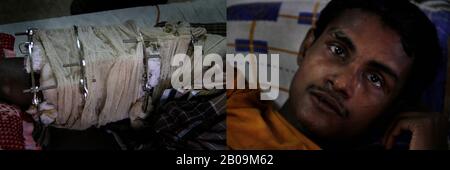 Lo sceicco Liton, 26 anni, ha rotto la gamba quando un camion in accelerazione ha colpito il suo furgone in risciò a Jessore. "Probabilmente non potrò mai più tirare il furgone in risciò. Mi auguro che il governo abbia fornito prestiti e corsi di formazione per gli handicap in modo che possano sopravvivere guadagnando un sostentamento". Monirampur, Jessore, Bangladesh. Agosto 28, 2011. Una di una serie di immagini della Photo Story, Tears on Highways, di Noor Alam. Foto Stock