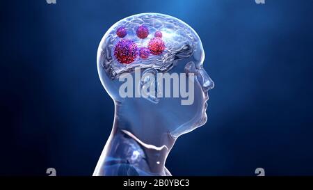 Brain cancer, illustrazione concettuale Foto Stock