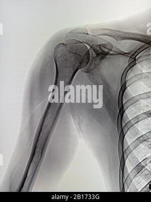 Immagine a raggi X dell'articolazione della spalla dolorosa o ferita, dislocazione della spalla. Medicina Foto Stock