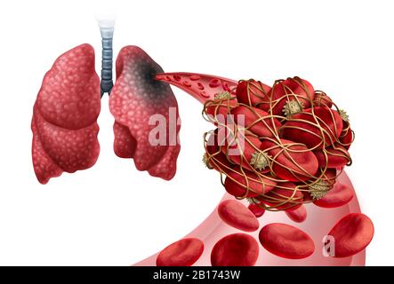 Embolismo polmonare con un coagulo di sangue come malattia con un blocco di un'arteria nei polmoni con elementi di illustrazione 3D. Foto Stock