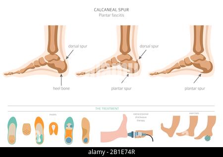 Sperone di calcare. Fasciitis plantar insieme. Raccolta di infografiche per disinfestazione medica. Illustrazione del vettore Illustrazione Vettoriale