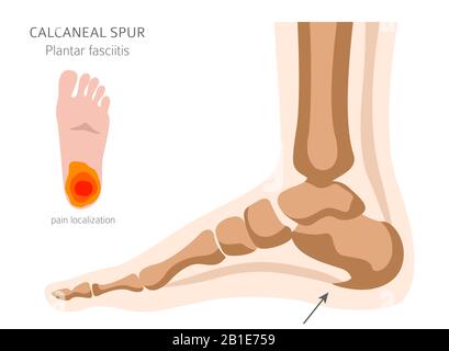 Sperone di calcare. Fasciitis plantar insieme. Raccolta di infografiche per disinfestazione medica. Illustrazione del vettore Illustrazione Vettoriale