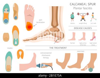 Sperone di calcare. Fasciitis plantar insieme. Raccolta di infografiche per disinfestazione medica. Illustrazione del vettore Illustrazione Vettoriale