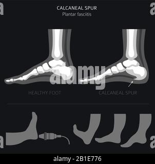 Sperone di calcare. Fasciitis plantar insieme. Raccolta di infografiche per disinfestazione medica. Illustrazione del vettore Illustrazione Vettoriale