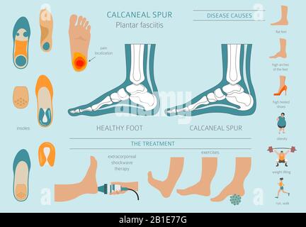 Sperone di calcare. Fasciitis plantar insieme. Raccolta di infografiche per disinfestazione medica. Illustrazione del vettore Illustrazione Vettoriale