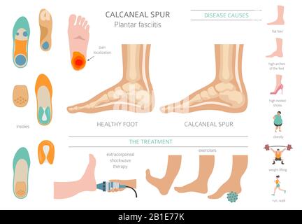 Sperone di calcare. Fasciitis plantar insieme. Raccolta di infografiche per disinfestazione medica. Illustrazione del vettore Illustrazione Vettoriale