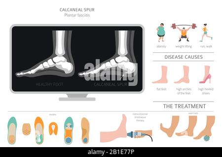 Sperone di calcare. Fasciitis plantar insieme. Raccolta di infografiche per disinfestazione medica. Illustrazione del vettore Illustrazione Vettoriale