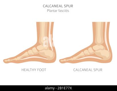 Sperone di calcare. Fasciitis plantar insieme. Raccolta di infografiche per disinfestazione medica. Illustrazione del vettore Illustrazione Vettoriale