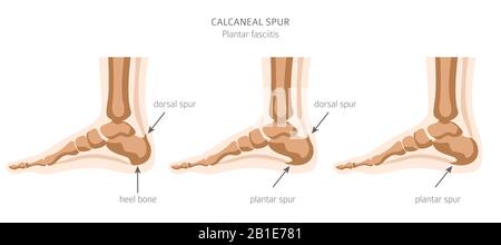 Sperone di calcare. Fasciitis plantar insieme. Raccolta di infografiche per disinfestazione medica. Illustrazione del vettore Illustrazione Vettoriale