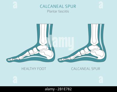 Sperone di calcare. Fasciitis plantar insieme. Raccolta di infografiche per disinfestazione medica. Illustrazione del vettore Illustrazione Vettoriale