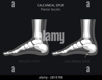 Sperone di calcare. Fasciitis plantar insieme. Raccolta di infografiche per disinfestazione medica. Illustrazione del vettore Illustrazione Vettoriale