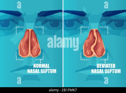 Sezione trasversale vettoriale del viso umano con setto nasale deviato e normale Illustrazione Vettoriale