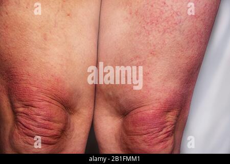 Gravi eruzioni allergiche sulle ginocchia. Immunità e reazione a prodotti allergenici. Eruzione cutanea dermatologica. Il problema della salute e della cosmetologia. Im Foto Stock
