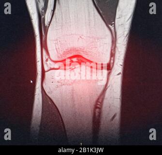 Un'istantanea della diagnosi di una MRI del ginocchio in cui artrosi e artrite. Il concetto di diagnosi congiunta mediante raggi X, trattamento delle malattie Foto Stock