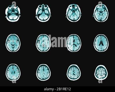 Set di immagini tomografiche per la testa umana e il cervello del computer. Partizione orizzontale dello studio medico o studio anatomico Foto Stock