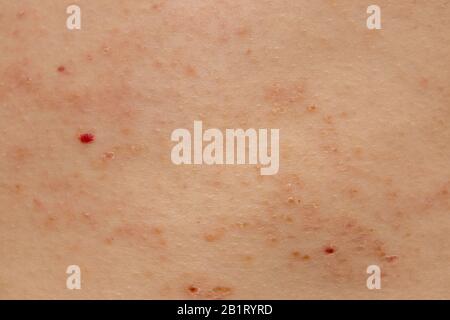 Herpes Zoster infezione Da Herpes Rash caucasico maschio 59 anni Foto Stock