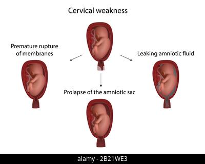 Complicazioni della debolezza cervicale, illustrazione Foto Stock