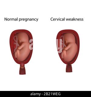 Debolezza cervicale e gravidanza normale, illustrazione Foto Stock