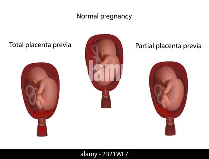 Salute, parziale e totale placenta previa, illustrazione Foto Stock