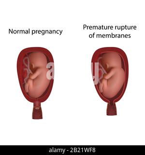 Rottura prematura delle membrane e normale, illustrazione Foto Stock