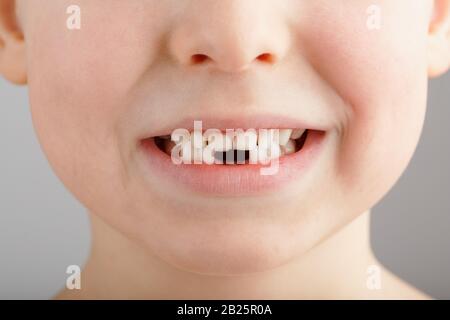 Un sorriso del bambino senza i denti più bassi del bambino. Un buco nel sorriso di un bambino. Concetto di divertimento. Servizio odontoiatrico Foto Stock