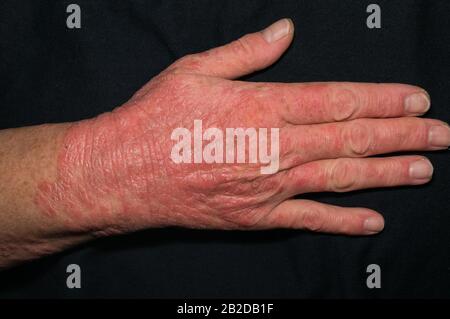 La mano del paziente con alterazioni tipiche della pelle in dermatosi croniche su sfondo nero. Psoriasi, eczema, dermatite. Primo piano. Messa a fuoco morbida. Foto Stock