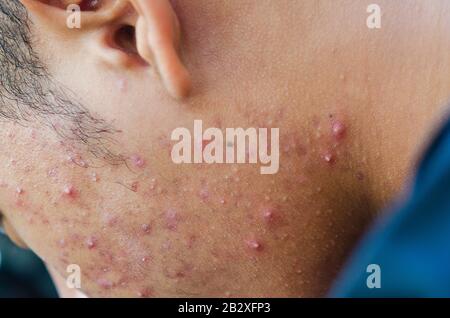 Acne infiammatoria sul viso Foto Stock