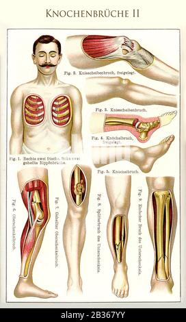 Sanità e medicina: Fratture ossee tabella colore II con diversi esempi di frattura di costole, gambe, caviglia e ginocchio con descrizioni tedesche Foto Stock