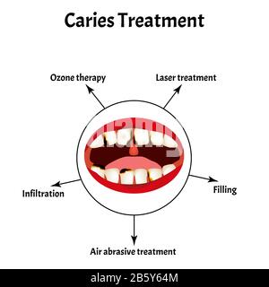 Malattie parassitarie di Phtiriasis. Pediculosi pubis. Struttura di ghiaccio pubico. Malattie sessualmente trasmissibili. Infografiche. Illustrazione del vettore attivata Illustrazione Vettoriale