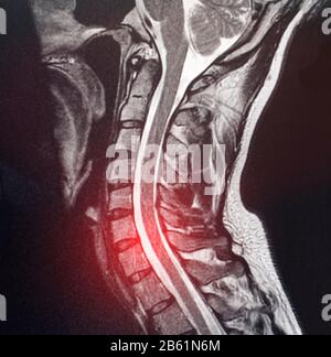 Immagine di risonanza magnetica della colonna cervicale di un paziente con dolore e intorpidimento al collo. Il concetto di diagnosi e trattamento della cervice uterina Foto Stock