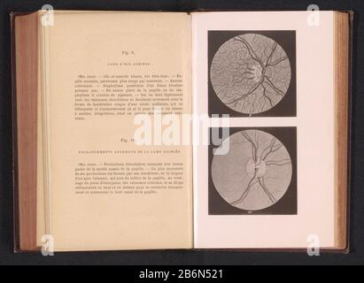 Fotoreproductie van twee anatomische tekeningen van een oog van iemand met albinisme en een oog met een zenuwaandoening Riproduzione fotografica Due disegni anatomici di un occhio di una persona con albinismo e un occhio con un disturbo nervoso tipo di oggetto: Fotomeccanica stampa riproduzione pagina numero articolo: RP-F 2001-7-168-5 Iscrizioni / marchi: Iscrizione, stampato a recto: 'La Fig. 9. Fond d d'oeil Albino Fig. 10. Promongements anormaux de la lame criblée' fabbricante : fabbricante: Anonimamente al disegno di: Anonymous date: CA. 1871 - in o davanti 1891 Materiale: Carta Tecnica: Leggera pressione dimensionale Foto Stock