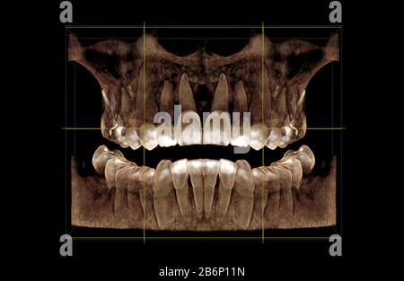 Visualizzazione 3D di un tomogramma computerizzato della dentizione, vista frontale Foto Stock