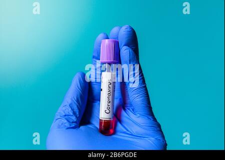 Risultato positivo del test del sangue per il nuovo Coronavirus, in rapida diffusione, Italia Foto Stock