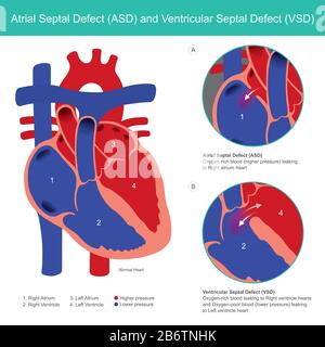 Difetto del setto atriale (ASD) e Difetto del setto ventricolare (VSD). Anomalie dell'atrio cardiaco e del ventricolo cardiaco dalla nascita del bambino. Illustrazione Vettoriale