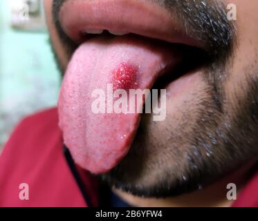 Un closeup di una lingua malata in cui un punto rosso glosse. Bruciore e fastidio della lingua Foto Stock