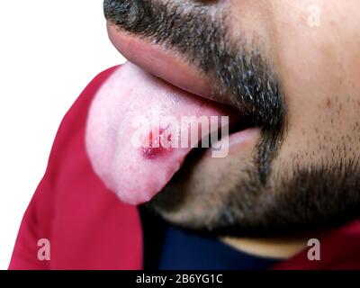 Un closeup di una lingua malata in cui un punto rosso glosse. Bruciore e fastidio della lingua Foto Stock