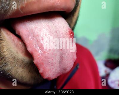 Un closeup di una lingua malata in cui un punto rosso glosse. Bruciore e fastidio della lingua Foto Stock