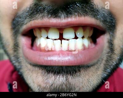 Un uomo con la barba mostra i denti, ha un'apertura dei denti. Foto Stock