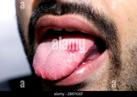 Un closeup di una lingua malata in cui un punto rosso glosse. Bruciore e fastidio della lingua Foto Stock