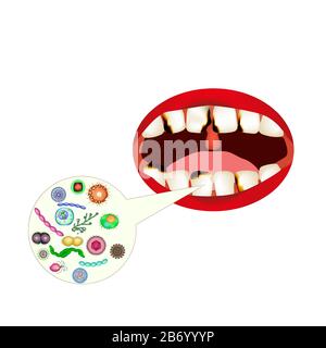 Malattie parassitarie di Phtiriasis. Pediculosi pubis. Struttura di ghiaccio pubico. Malattie sessualmente trasmissibili. Infografiche. Illustrazione del vettore attivata Illustrazione Vettoriale