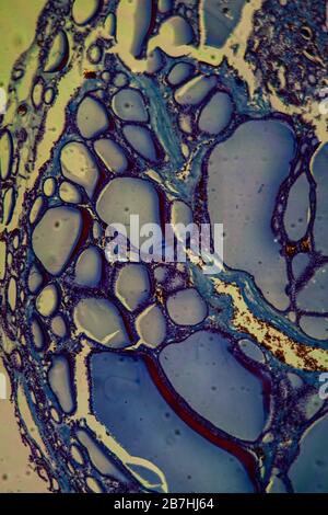 Goitre colloid goitre malattia 100x Foto Stock