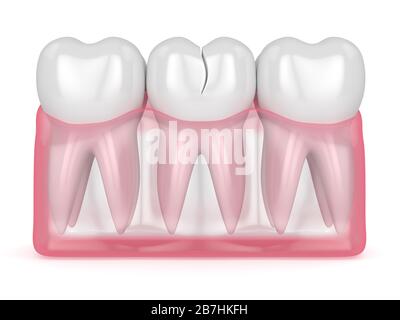 rendering 3d di gengive traslucide con dente fessurato su sfondo bianco. Diversi tipi di denti rotti concetto. Foto Stock