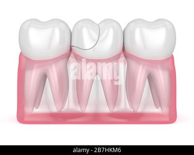 rendering 3d di gengive traslucide con dente fessurato su sfondo bianco. Cuspidi fratturate. Diversi tipi di denti rotti concetto. Foto Stock