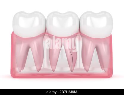 rendering 3d delle gengive con radice dentaria incrinata su sfondo bianco. Frattura verticale. Diversi tipi di denti rotti concetto. Foto Stock