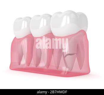 rendering 3d delle gengive con radice dentaria incrinata su sfondo bianco. Diversi tipi di denti rotti concetto. Foto Stock