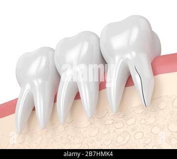 rendering 3d delle gengive con radice dentaria incrinata su sfondo bianco. Frattura verticale. Diversi tipi di denti rotti concetto. Foto Stock