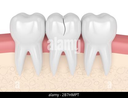 rappresentazione 3d delle gengive con dente trattabile fessurato su sfondo bianco. Diversi tipi di denti rotti concetto. Foto Stock